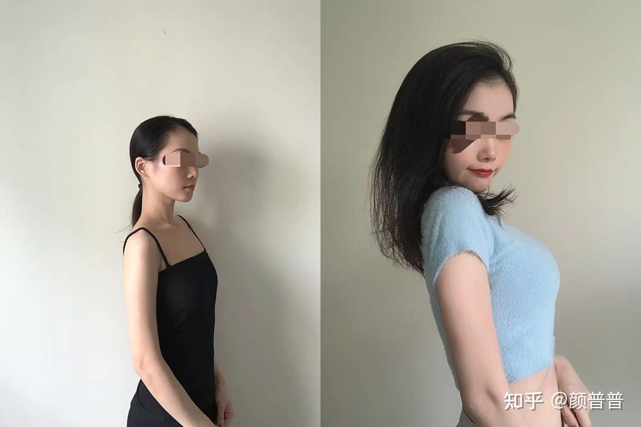 時光對話:小雅與李醫(yī)生探尋假體隆胸260和280圖片的尺寸奧秘
